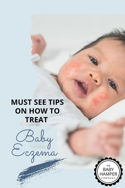 Must See Tips On How To Treat Baby Eczema